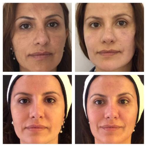 Chemical peeling Before / After photo